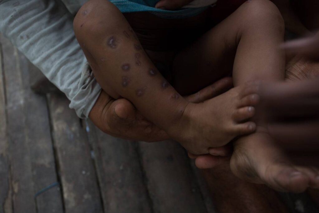 Afectaciones en la salud de niños y niñas de la comunidad kichwa de Isla Sani provocadas por el derrame del 7 de abril del 2020 en las comunidades que viven a orillas del río Napo, 2020.  Fotos: Ivan Castaneira en Instagram @i_chido