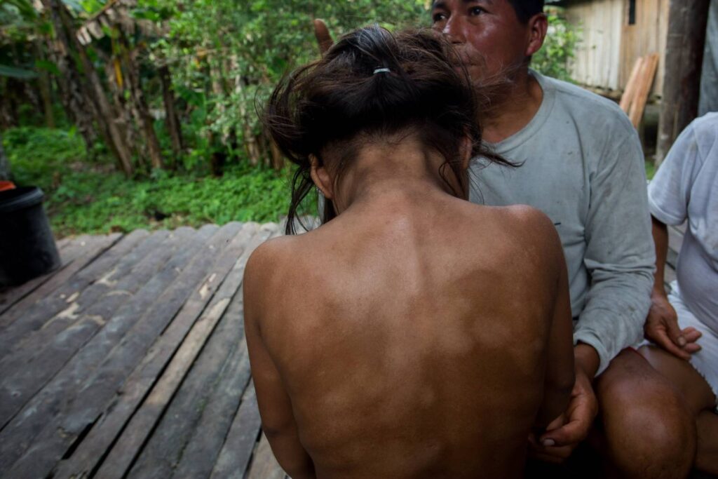 Afectaciones en la salud de niños y niñas de la comunidad kichwa de Isla Sani provocadas por el derrame del 7 de abril del 2020 en las comunidades que viven a orillas del río Napo, 2020.  Fotos: Ivan Castaneira en Instagram @i_chido